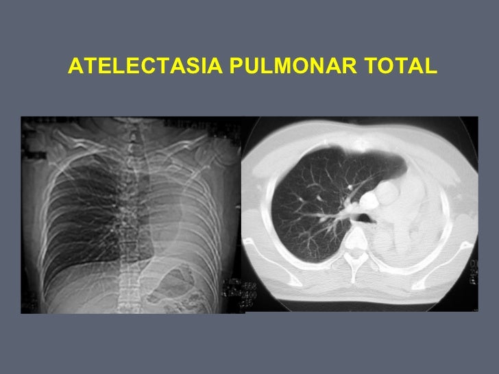 2. atelectasia pulmonar