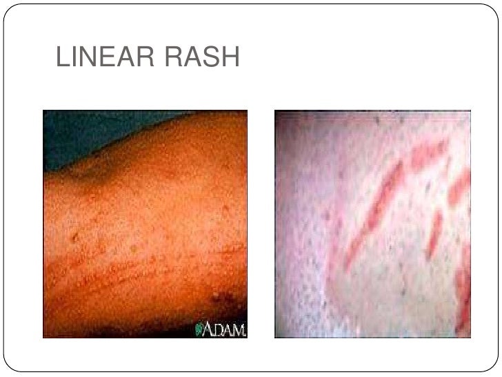 Linear Rash - Doctor answers on HealthTap