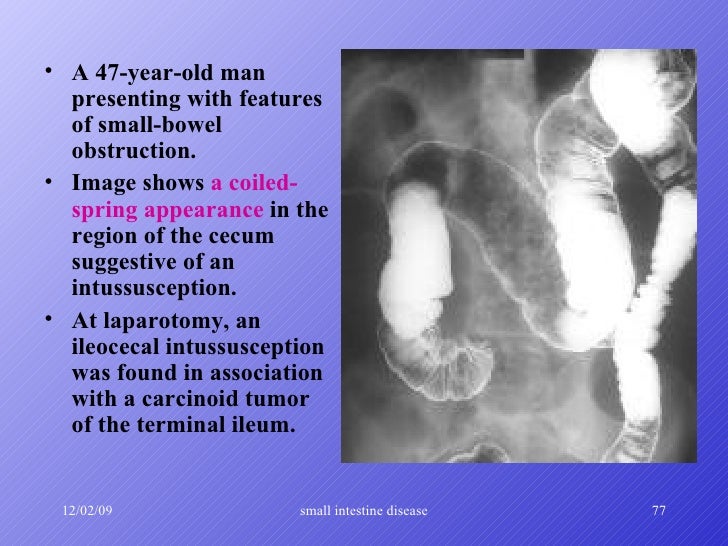 small intestine diseases 2