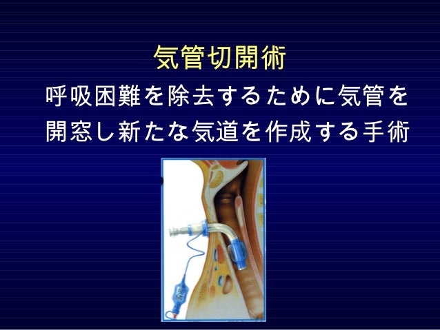 気管切開術とカニューレ