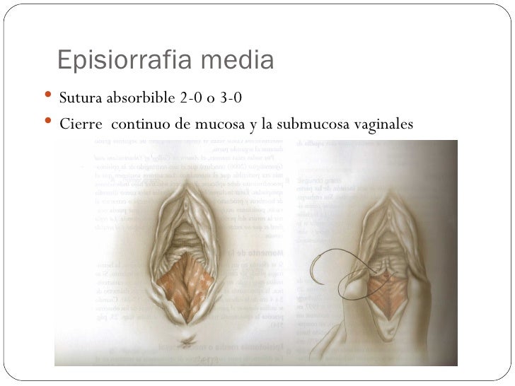 20110526 episiotomias y_desgarros