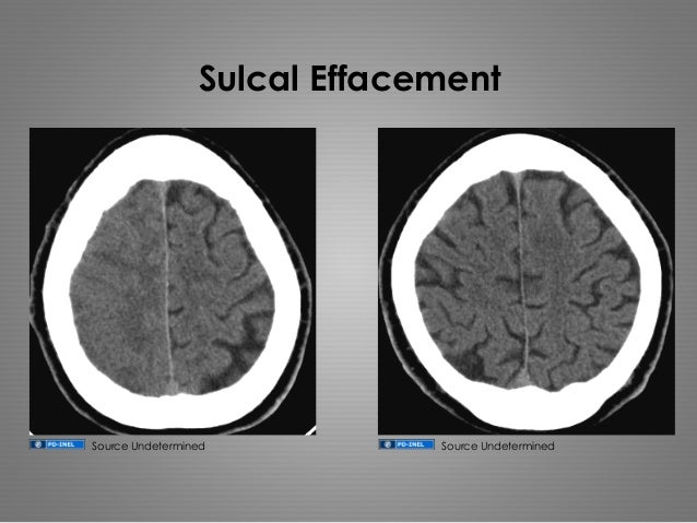 stroke management nz