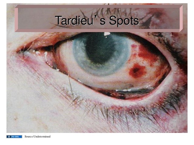 GEMC- Hanging and Strangulation, Asphyxiation & AeA "The Choking Game…