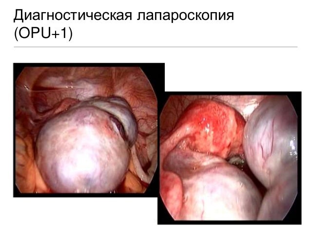 Мультифолликулярный яичник и зачатие Мультифолликулярный яичник и зачатие