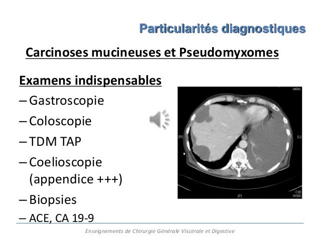 Cancer Ovaire Marqueurs Tumoraux