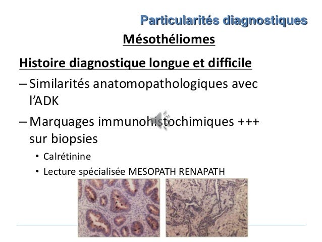 most cancers des poumons sans fumer