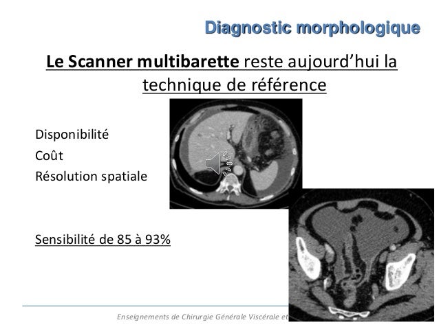 Cancer Du Pancréas Douleurs Abdominales