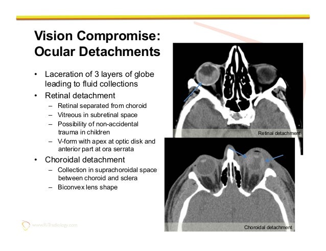 Facial nerve impingement Isaac trisha blow job real world australia reunion