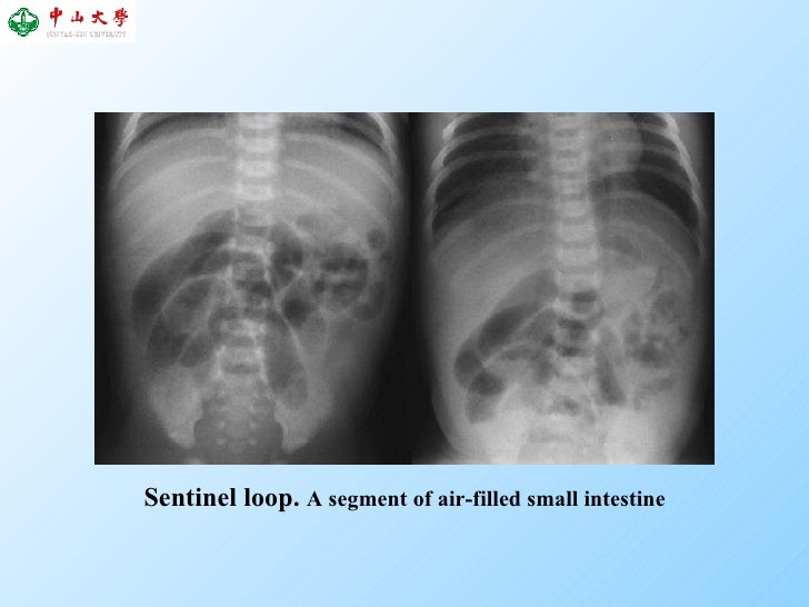 22 acute pancreatitis