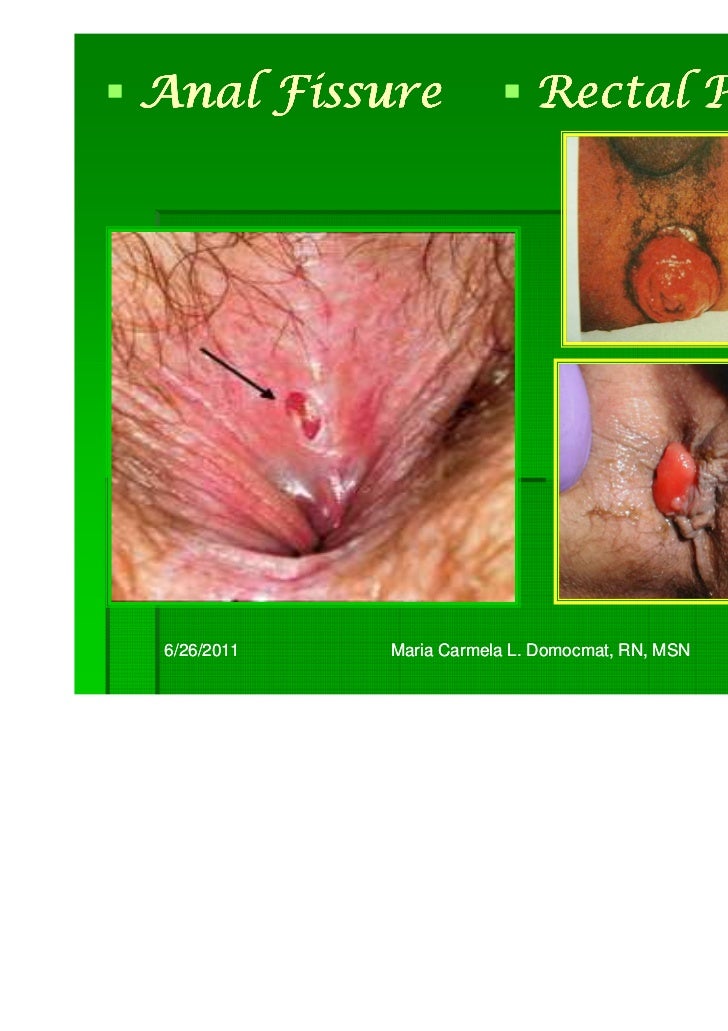 anal herpes picture