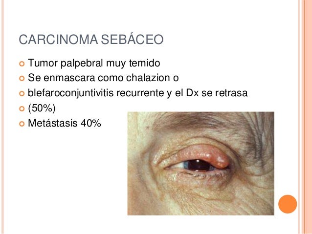 El Cancer En Ancianos Es Mas Lento