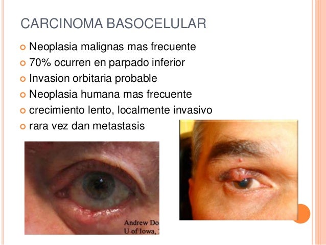 El Cancer En Ancianos Es Mas Lento