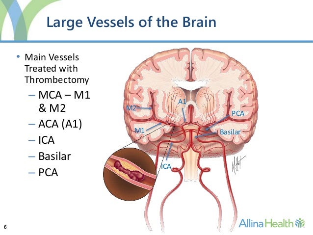 ayurvedic remedy of brain stroke patients