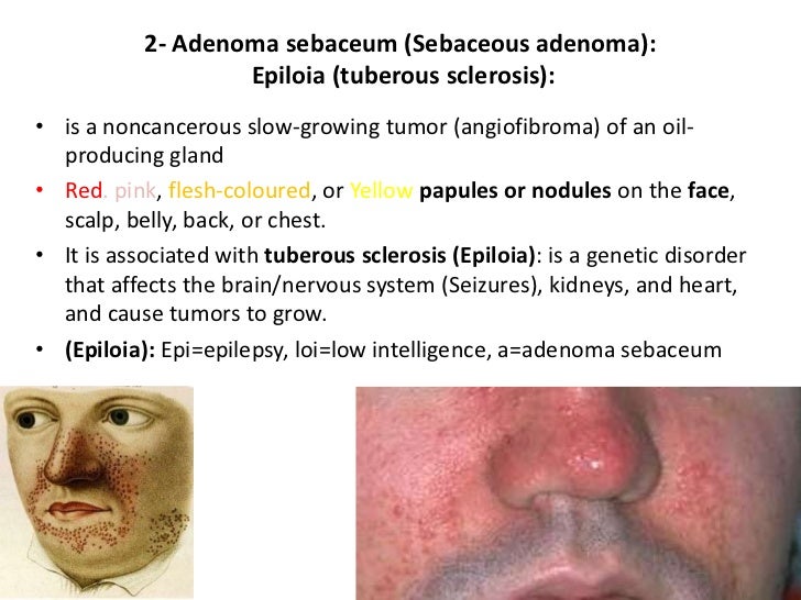 Sebaceous gland - Wikipedia