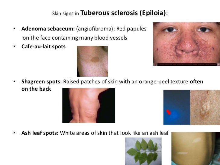 Sebaceous Hyperplasia - Causes, Pictures, Symptoms ...