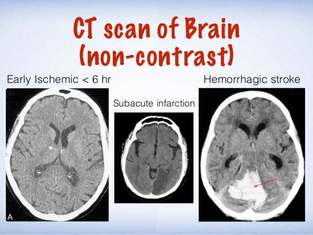 stroke unable to swallow