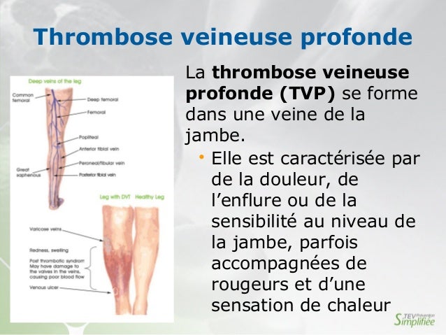 Les golfs de compresseur de la varicosité