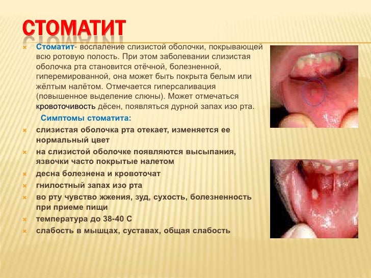 Слизистая рта нормальный цвет Слизистая рта нормальный цвет