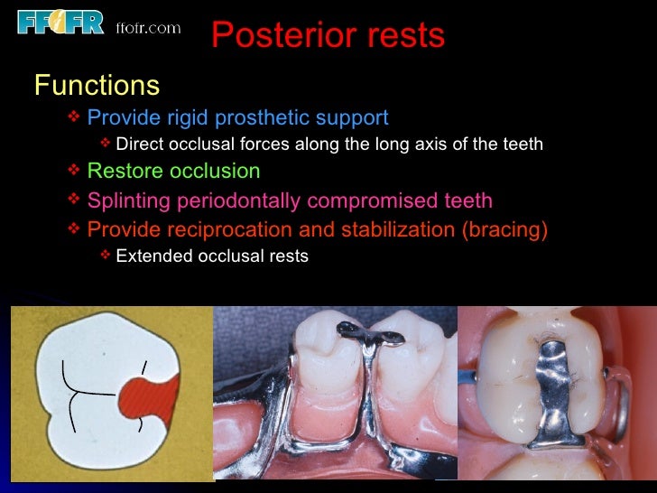 3.partial denture rests