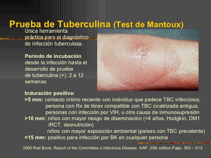 30. tuberculosis extrapulmonar 30. tuberculosis extrapulmonar