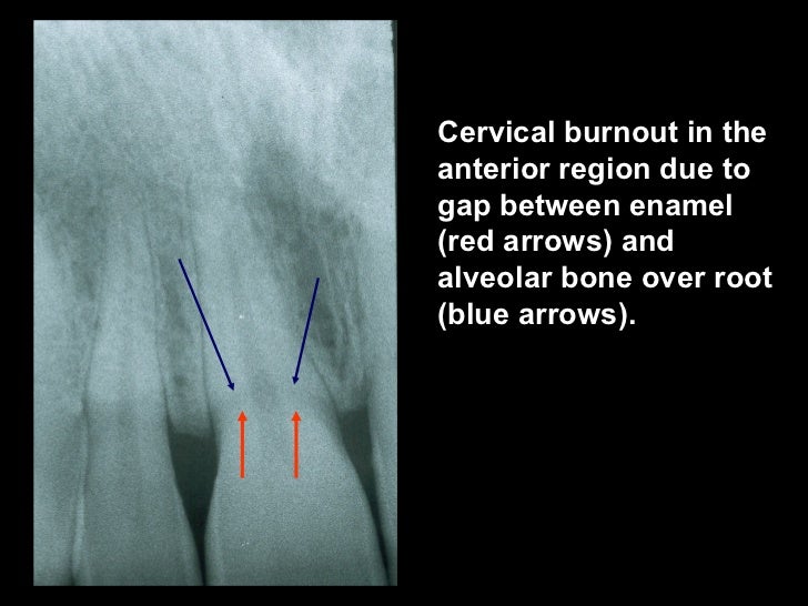 radiographiccariesdiagnosis