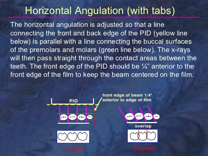 radiologybitewingtechnique