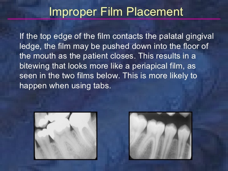 radiologybitewingtechnique