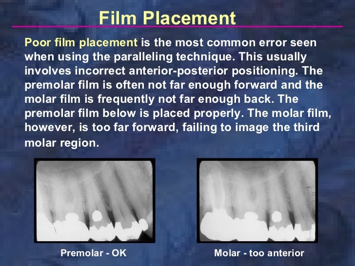 radiologyparallelingtechnique