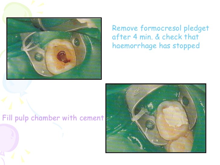 pulpotomy procedures in primary dentition