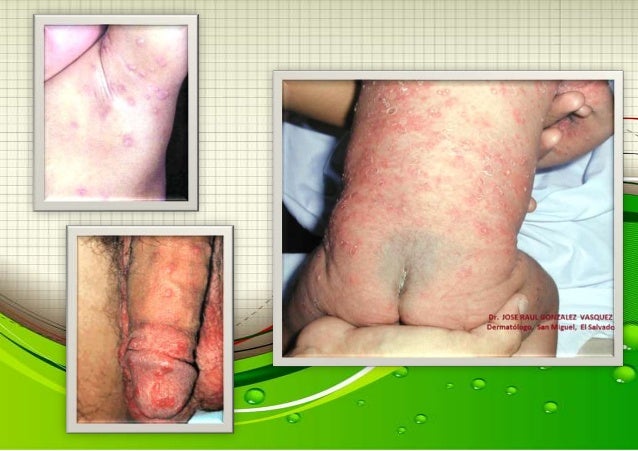 Deksametazon el esquema de la aplicación a atopicheskom la dermatitis