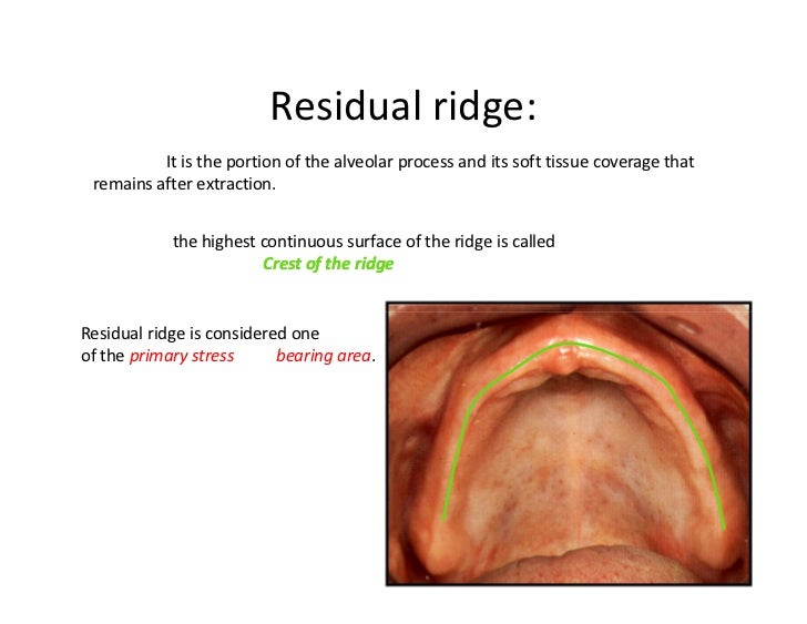 classification of edentulous ridge