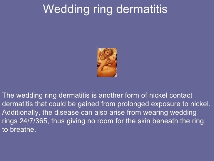 wedding ring dermatitis