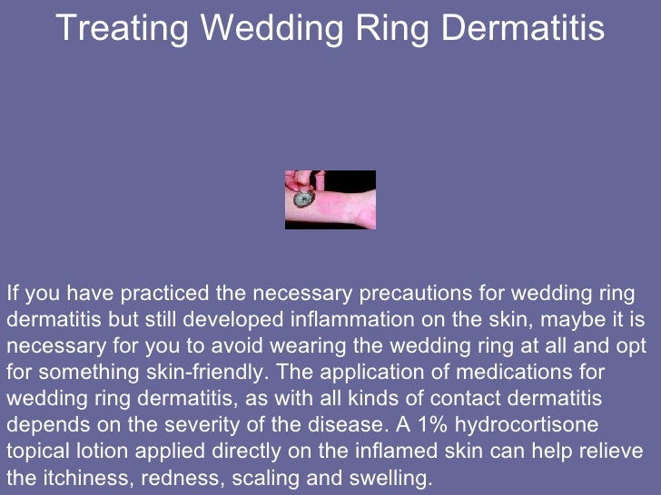 White gold wedding ring causes rash