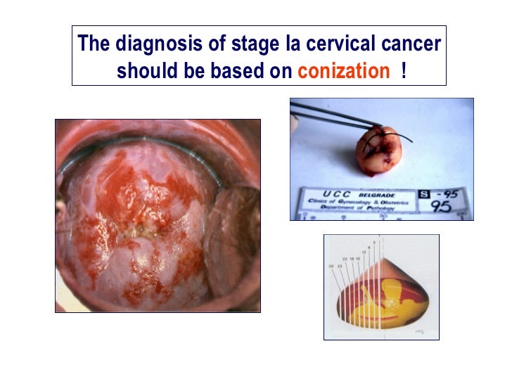 Cancer Cervical tiers