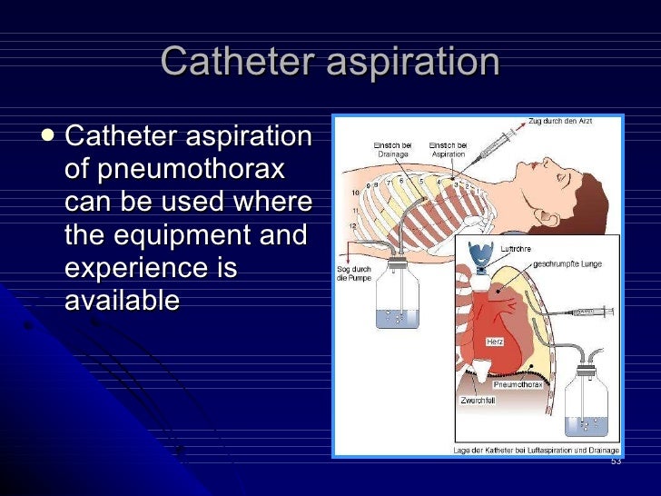 3 pneumothorax