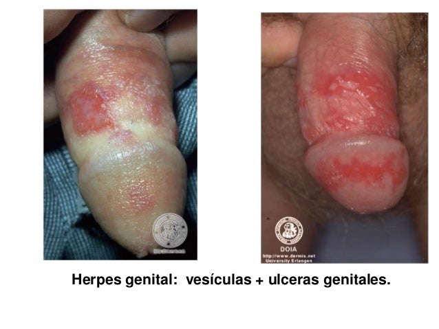 Early Hiv Folliculitis - The Body