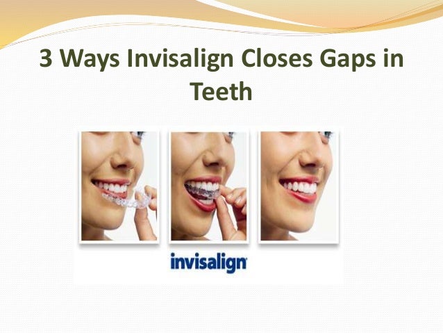 invisalign on gapped teeth invisalign on gapped teeth