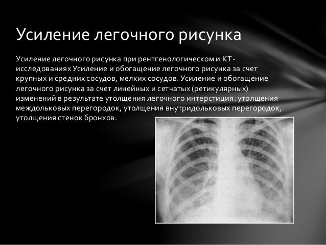 Что значит усиленный рисунок легких что это такое Что значит усиленный рисунок легких что это такое