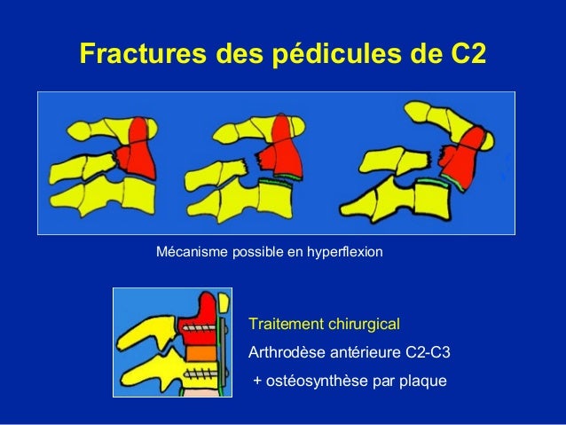 Les myodynies constantes dans le cou