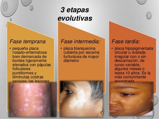 La psoriasis del ungüento en base al alquitrán