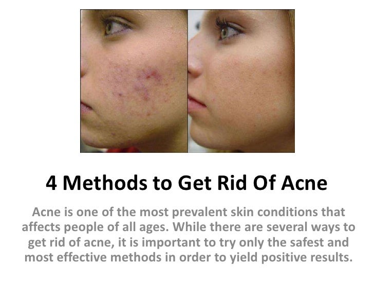 4 methods to get rid of acne