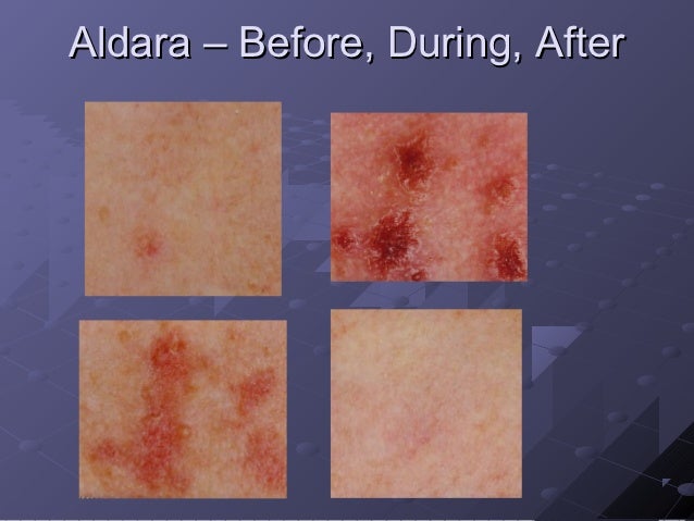 problems with aldara cream