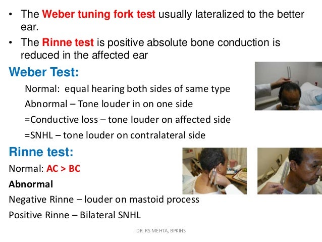 weber tuning fork conductive hearing loss weber tuning fork conductive hearing loss