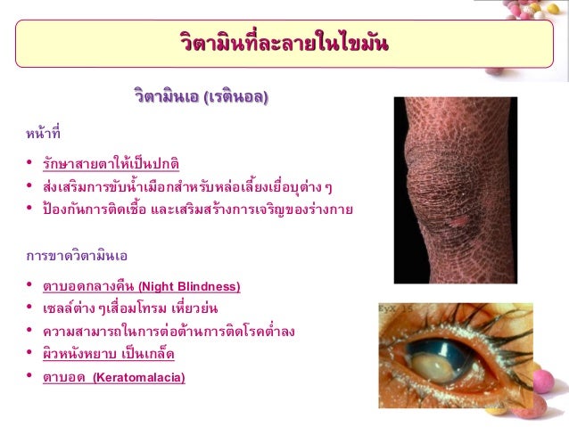 ขาดวิตามินเอ