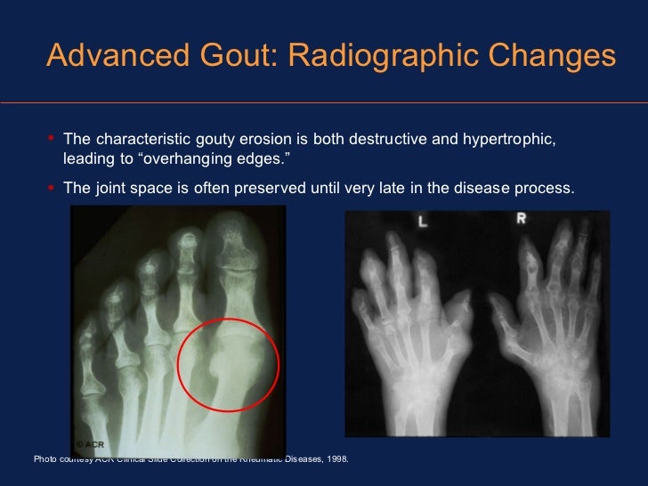 Watch How to Treat Hyperuricemia video Watch How to Treat Hyperuricemia video