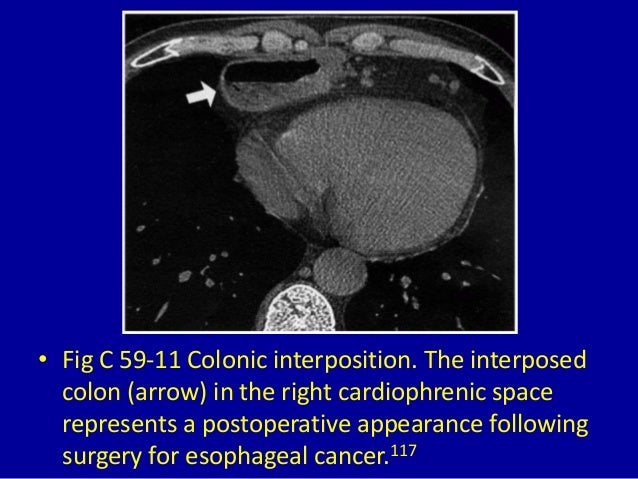 mesothelioma solicitors manchester