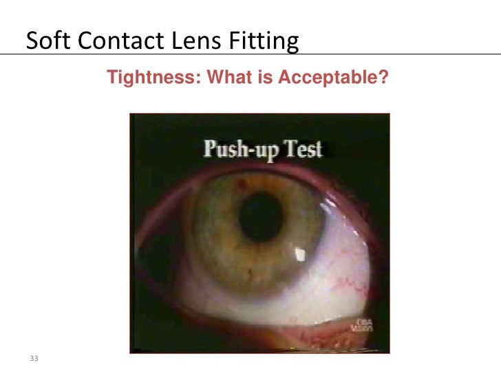 Soft Contact Lens Fitting
