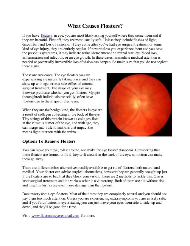 What Causes Floaters?If you have floaters in eye, you are most likely 