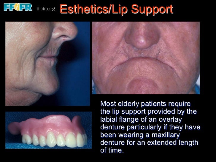 Edentulous Maxilla Overlay Dentures