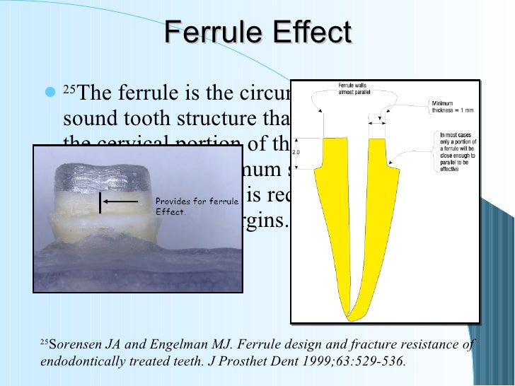 6 restoration Of The Endodontically Treated Tooth 6 restoration Of The Endodontically Treated Tooth